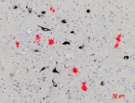 Hirngewebe einer Maus mit Alzheimer-ähnlichen Symptomen. Beta-Amyloid-Plaques