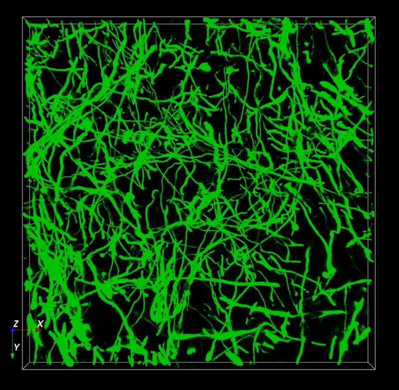 Vernetzte Tumorzellen aus Glioblastomen (grün) 
